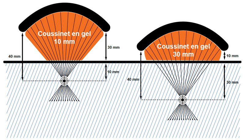 Schéma de fonction du traitement par ondes de choc focales avec l'endopuls FSWT